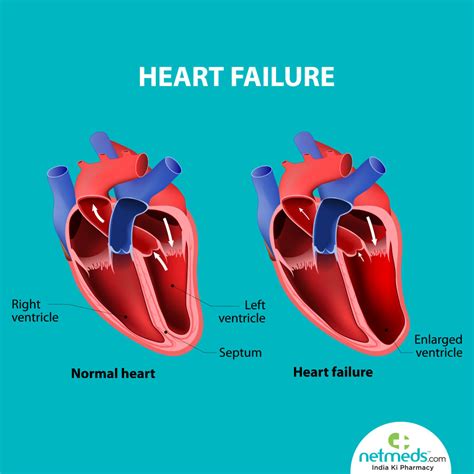 causes of left ventricular failure.